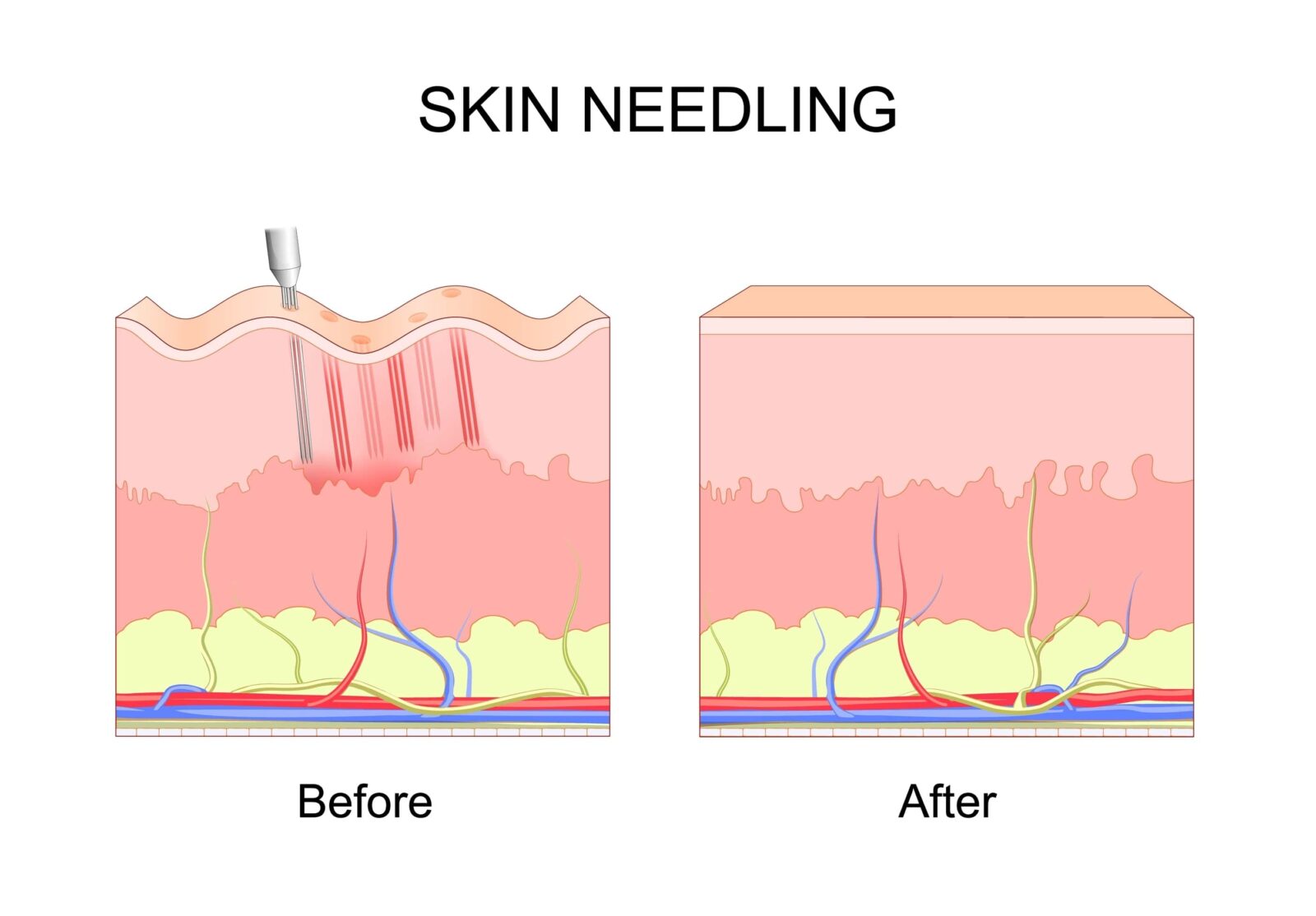 Wireless Microneedling Derma Pen/Mas Pen L3 Skin Care Tool